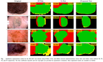 DSNet: Automatic dermoscopic skin lesion segmentation